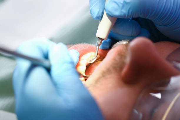 Best Emergency Broken Tooth Repair in Olympia, SC